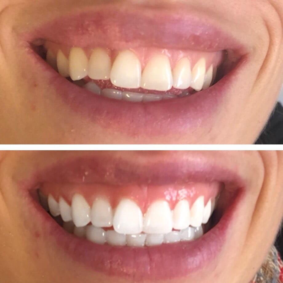 diamondsmile-zahnbleaching-white-strips-flexible-strips-f-r-zu-hause image 8