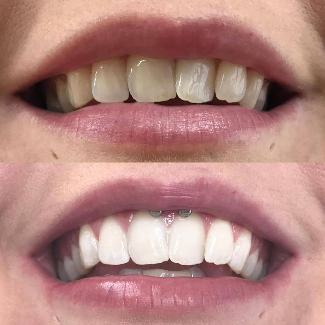 diamondsmile-zahnbleaching-stift-f-r-unterwegs image 8