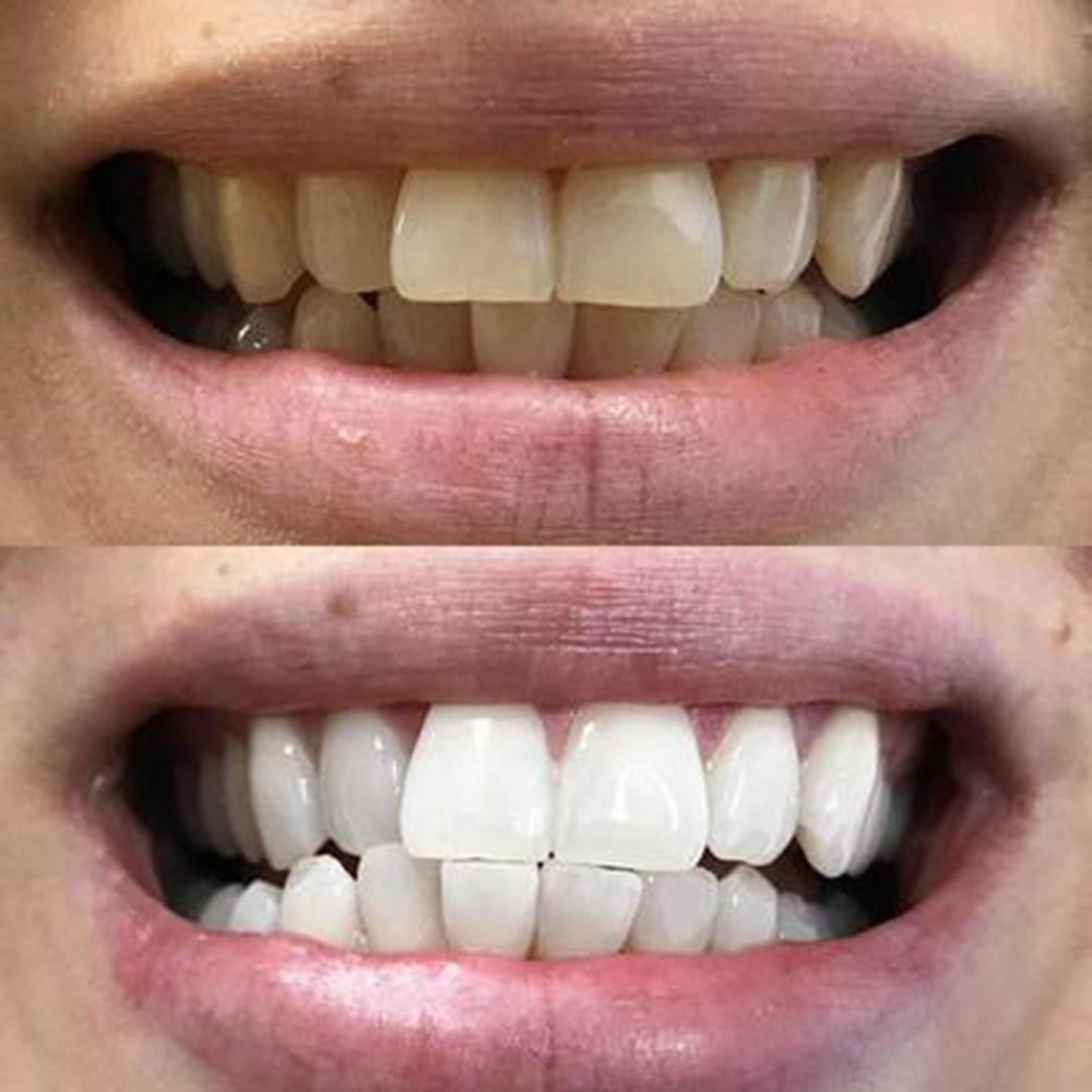 diamondsmile-zahnbleaching-schaum-f-r-zahnzwischenr-ume image 7