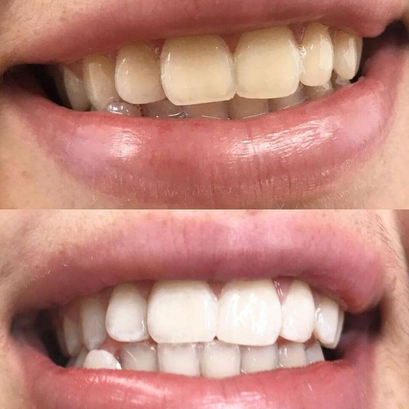 diamondsmile-zahnbleaching-farbkorrektur-schaum-sofort-effekt-ab-anwendung-1 image 7