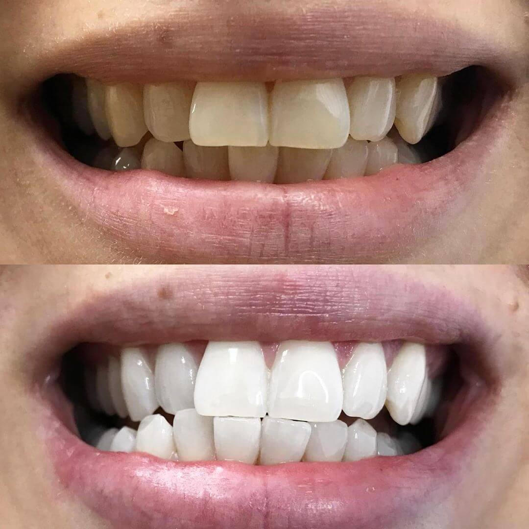 diamondsmile-zahnbleaching-stift-f-r-unterwegs image 7