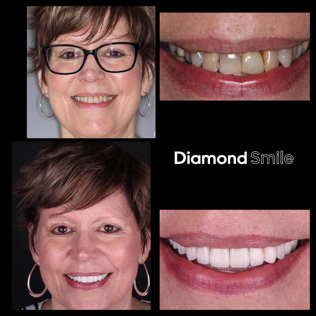 diamondsmile-farbkorrektur-zahnbleaching-stift-violett image 7