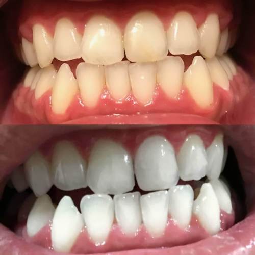 diamondsmile-zahnbleaching-zahnpasta-pap-schmelzschonend image 4