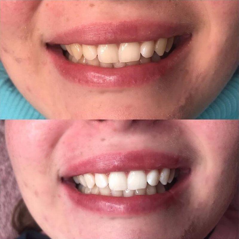 diamondsmile-pap-zahnbleaching-gel-schonende-aufhellung-ohne-sensitivit-t image 7