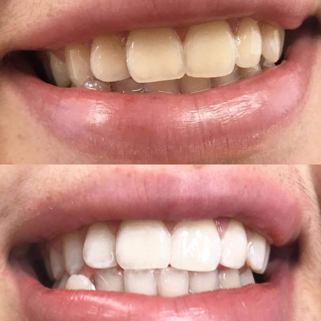 diamondsmile-whitecare-zahnbleaching-kur-all-in-one-bleaching-set-mit-power-led image 8