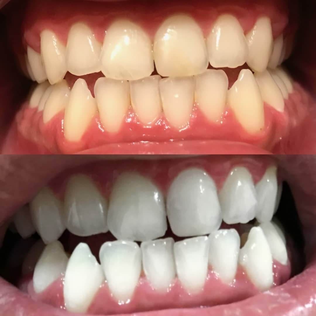 diamondsmile-zahnbleaching-stift-f-r-unterwegs image 6