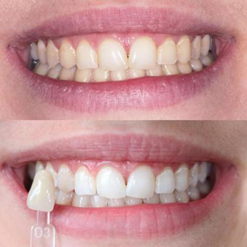 diamondsmile-farbkorrektur-zahnbleaching-stift-violett image 8