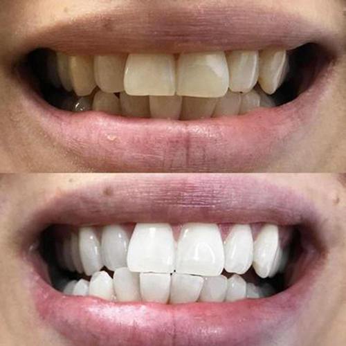 diamondsmile-black-aktivkohle-zahnbleaching-strips image 5