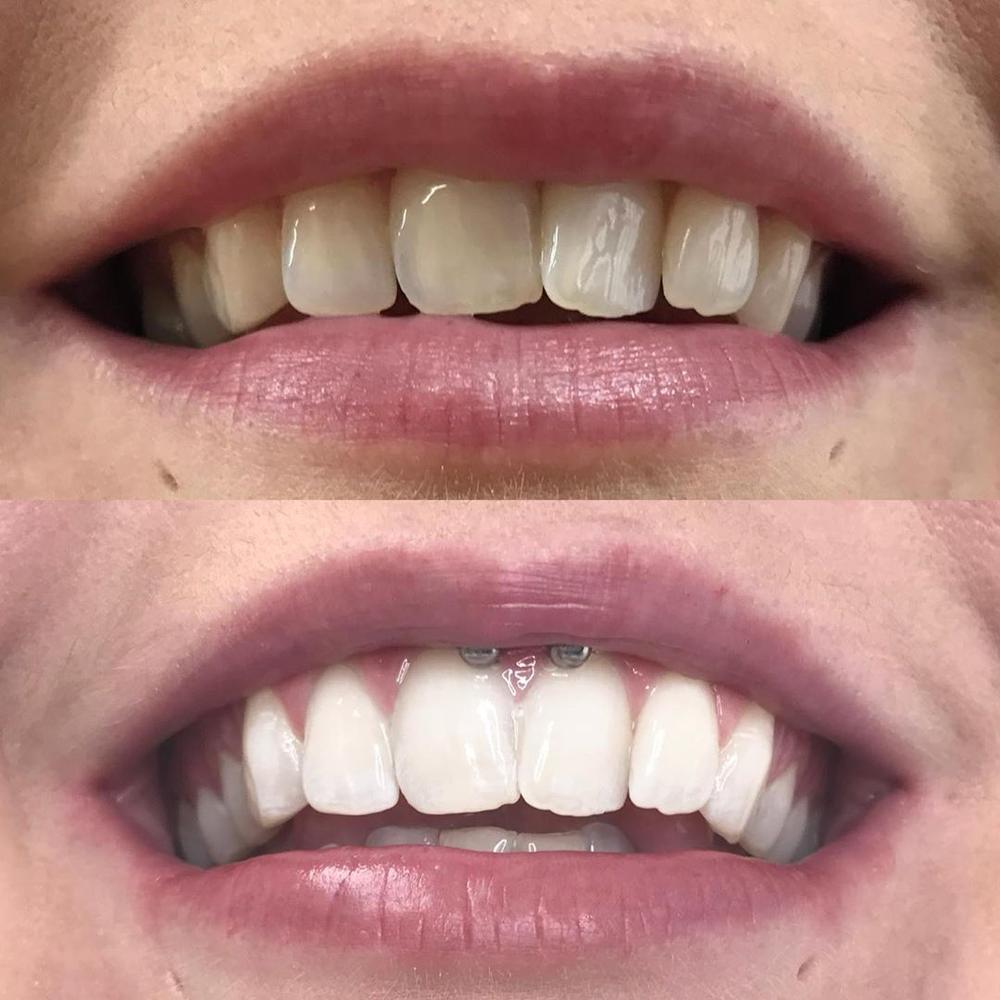 diamondsmile-zahnbleaching-farbkorrektur-serum-sofort-effekt-serum-gegen-flecken image 8